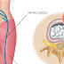 Como aliviar rápidamente el dolor del nervio ciático