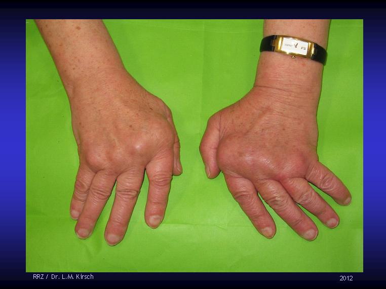 Rheumatologe Rheumatoide Arthritis Alte und neue