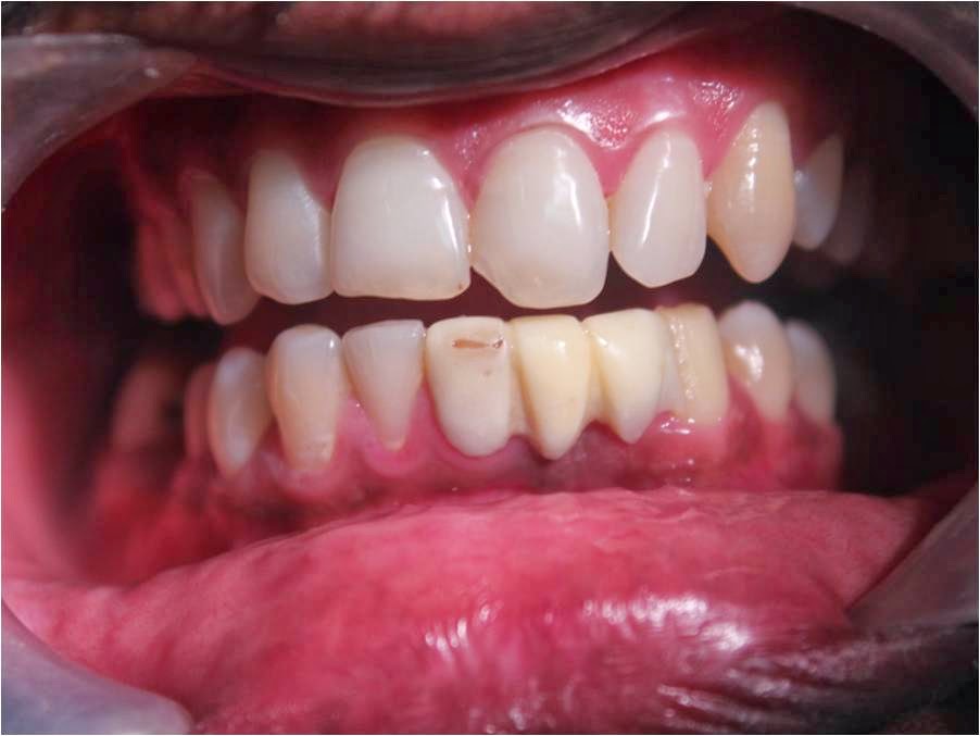 Multiple dental implants and zirconium bridges for smile designing