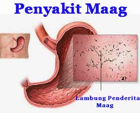 perut sakit dan kembung perut sakit dan kembung