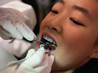 Quy trình niềng răng cho trẻ có nhanh không? Quy-trinh-nieng-rang-cho-tre-co-nhanh-khong