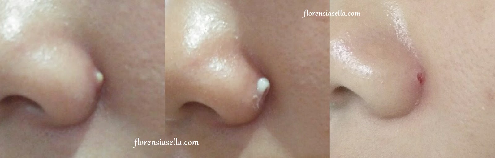 everwhite acne cream