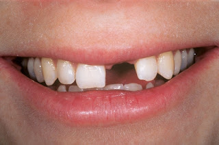 Yếu tố gây mất răng Yếu tố gây mất răng