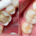 Cho ý kiến: bọc răng sứ loại nào tốt?