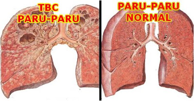 Foto Paket obat infeksi paru paru