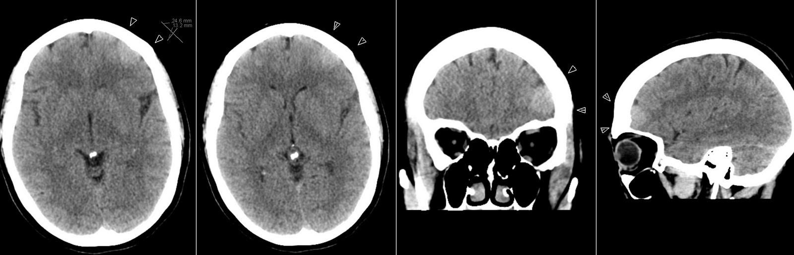 Radiology MRI Incidental Meningioma radiology-mri-incidental-meningioma