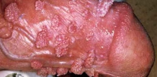 genital warts just won't go away pictures genital warts just won't go away pictures