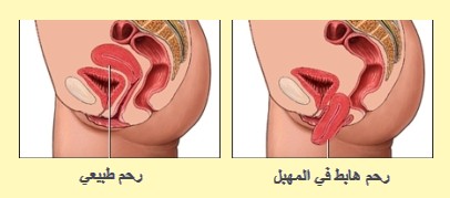 للنساء فقط اعراض نزول المهبل وأسبابه وكيفية علاجه ونصائح للوقاية منه Ma Tunisie