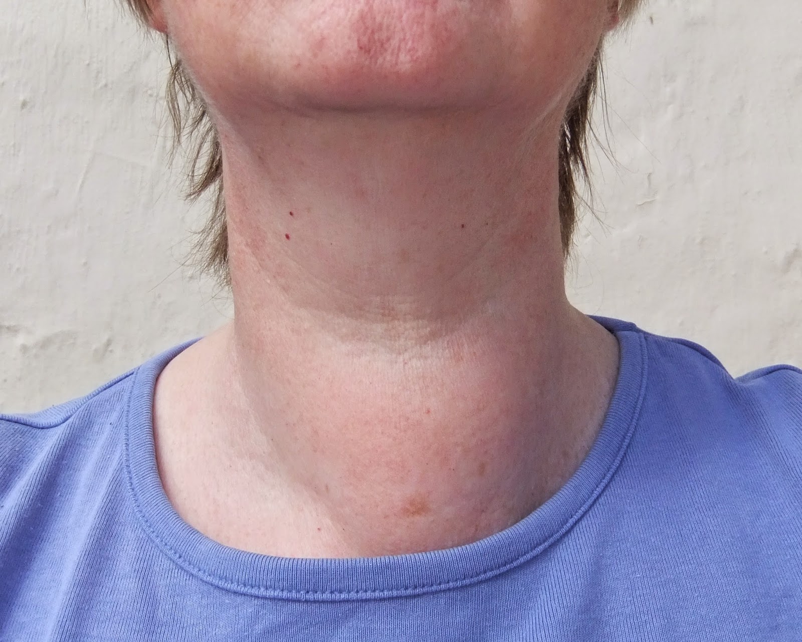 before thyroidectomy partial goitre