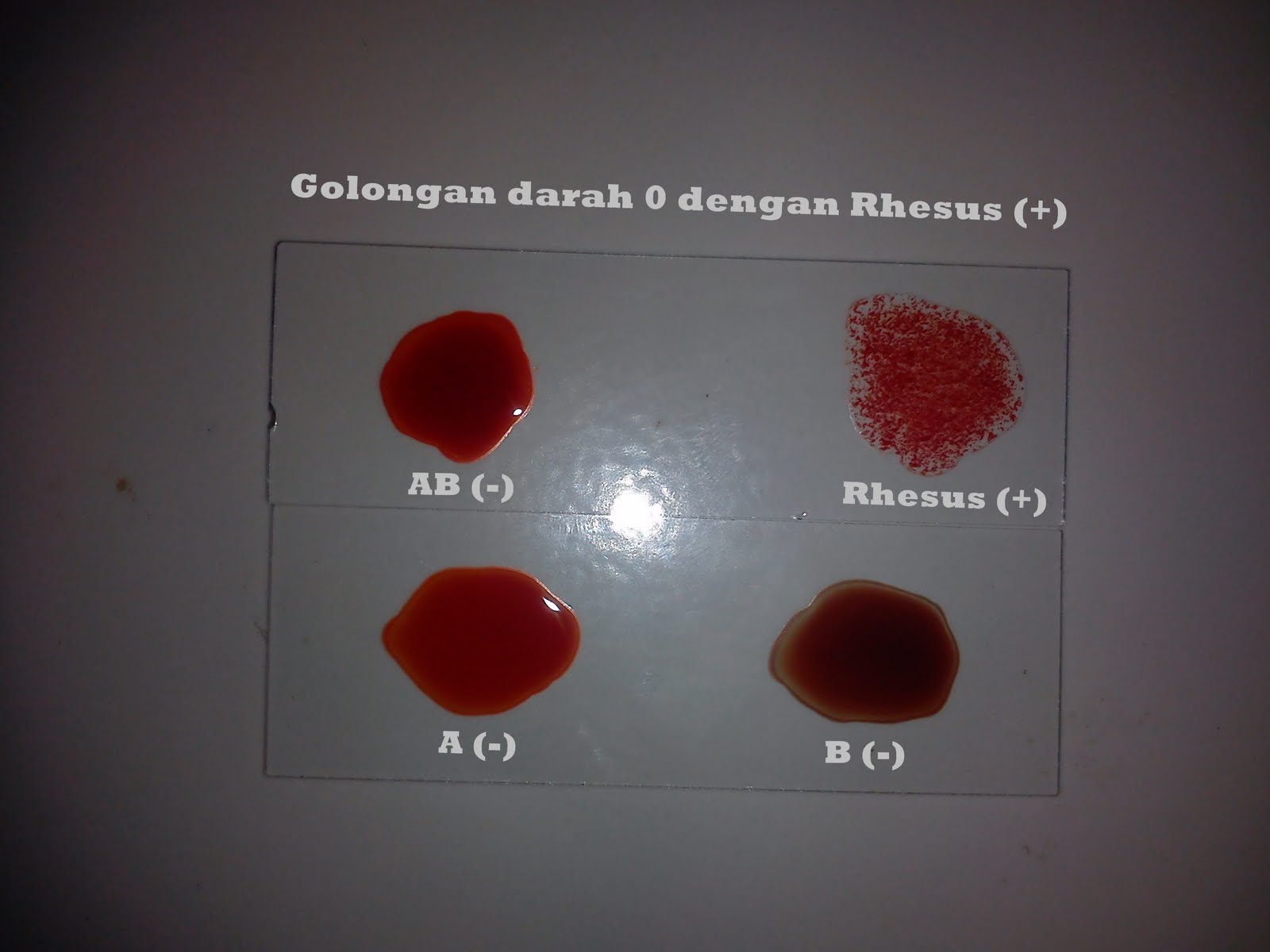 Pemeriksaan Golongan  Darah  dan Rhesus Analis Kesehatan