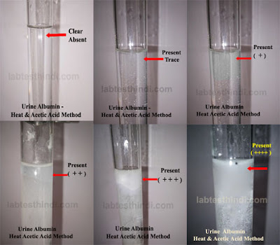 Urine  Albumin Test  Heat & Acetic Acid Method