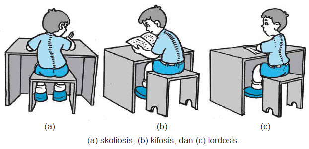 Jelaskan Perbedaan Antara Kifosis Lordosis Dan Skoliosis