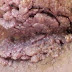 Penyebab Kutil Kelamin Hpv thumbnail