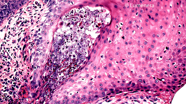 Microscopy image of Cellular Neurothekeoma captured with the Infinity 2-5 microscope camera at 200x.