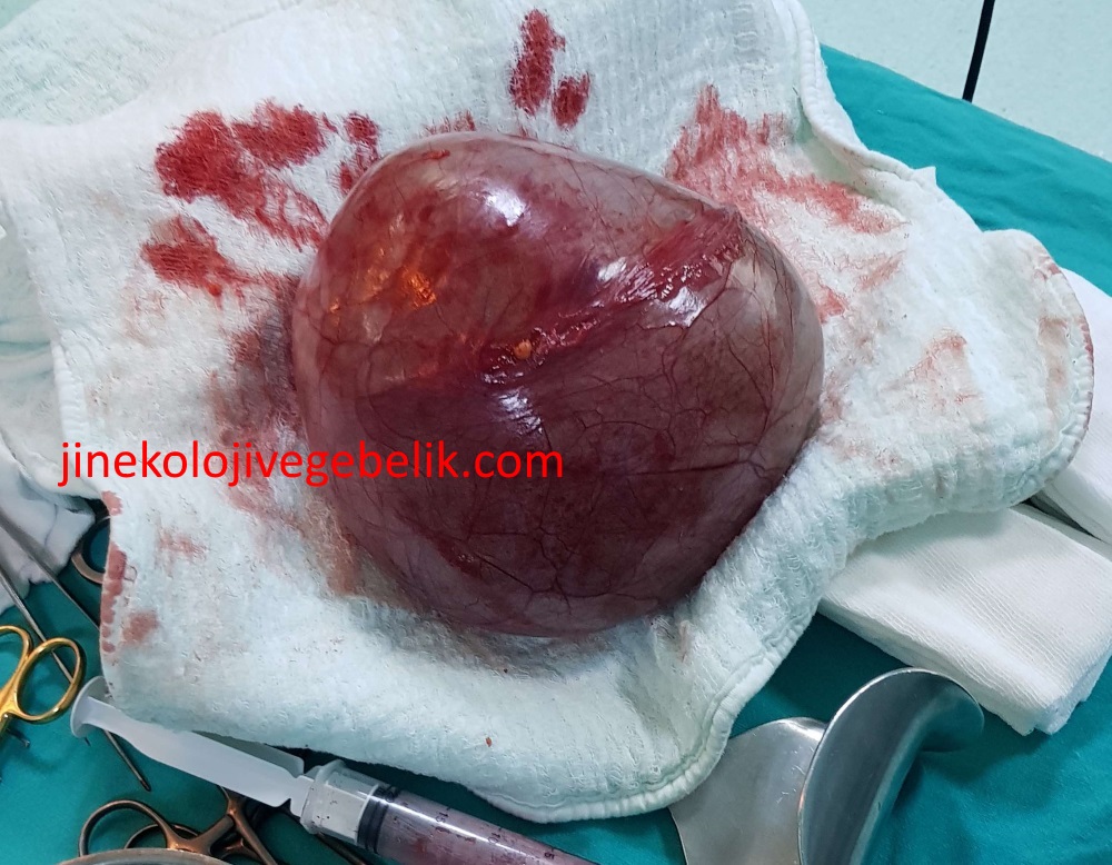 Torsiyone Olmus Burkulmus 15 Cm Over Kisti Ameliyat Sirasinda Cekilen Fotografta Kistik Renginin Burkulmadan Dolayi Kirmizi Mor Oldugu Goruluyor Torsiyone Olmus Burkulmus 15 Cm Over Kisti Ameliyat Sirasinda Cekilen Fotografta Kistik Renginin Burkulmadan Dolayi Kirmizi Mor Oldugu Goruluyor