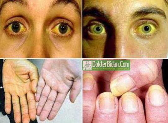 Demam Kuning - Penyebab Gejala Pencegahan dan Cara Mengobatinya Dengan Obat Herbal Tradisional dan Apotik Resep DOkter Demam Kuning - Penyebab Gejala Pencegahan dan Cara Mengobatinya Dengan Obat Herbal Tradisional dan Apotik Resep DOkter
