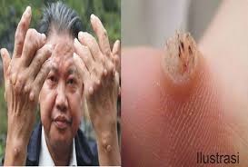 Foto Kutil Kelamin Dan Cara Menghilangkan Kutil Dengan Obat Kutil Herbal