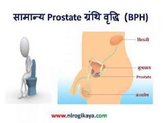 Benign Prostatic Hyperplasia (BPH) Symptoms, Causes & Treatment in Hindi