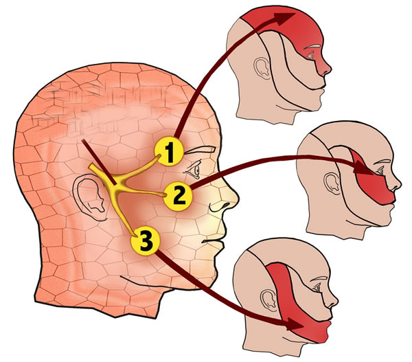 Trigeminal neuralgia