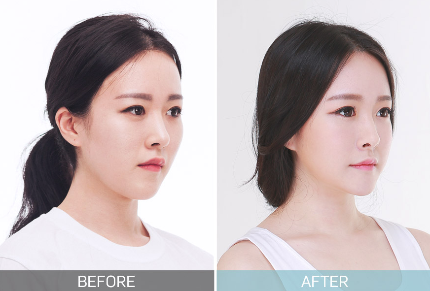 UVOM Plastic Surgery in Korea facial contouring surgery zygoma reduction experience