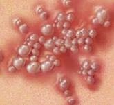 herpes obat herpes