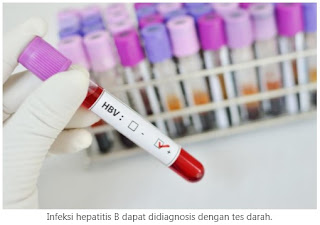 Hepatitis B: Penyebab, Gejala dan Pengobatan Hepatitis B: Penyebab, Gejala dan Pengobatan
