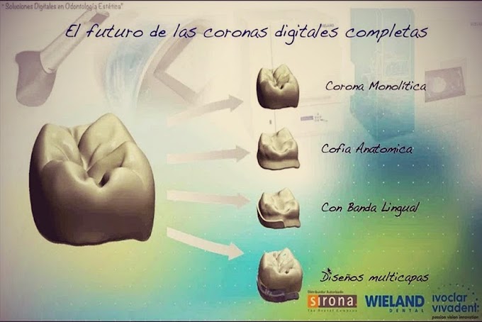 SISTEMA WIELAND: Desarrollando Coronas Digitales - Videoconferencia de los Dres. Hernández y Núñez