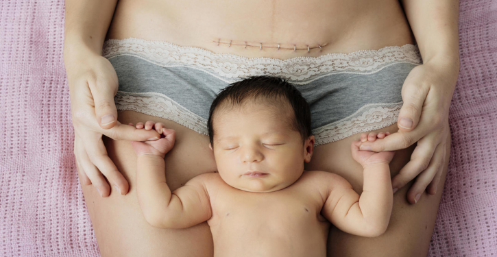 Everyone Needs To Know These 3 Things About Women Who Have A Caesarean Section