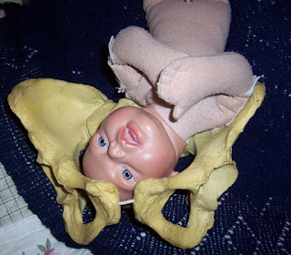 Spinning Babies Asynclitism is when baby's head is tipped as if listening. This is an issue in the midpelvis, after engagement. Often, the baby's head is angled so that more of the head is trying to get through at one time. Also baby's neck is not aligned with the uterine contraction. It seems that baby's head is too big to fit lower. That is, baby may be at the wrong angle to fit through a narrow midpelvis. Posterior and asynclitic may be an issue at the inlet but I think this is more about a lack for flexion and the posterior angle crossing over the edge of the front of the pelvis. Rotation solves that issue, whereas making room in the midpelvis and trying to align baby seem to help in the following case. The first Spinning Babies presentation in Brazil on 2 June 2015.
Which one of these midwives and obstetricians helped a colleague avoid a cesarean before the class was even over? At the Sia Parto Simposio in Brazil this week, Ana Paula tells how a midwife at my first class saw how to help an asynclistic labor continue more easily and quickly called her obstetric colleague at the hospital. The obstetrician was patiently waiting while the mother was 7 cm for 5 hours without progress. My participant texted instructions and showed images the techniques (see them at www.SpinningBabies.com).
Hear what happened!
Enjoy this testimony in a quiet listening place. We recorded this in busy "lobby" of the Sia Parto Symposium in São Paulo. You can see these techniques in the Spinning Babies Parent Class. And you can read what to do for an Asynclitic baby at https://www.spinningbabies.com/learn-more/baby-positions/other-fetal-positions/asynclitism/ These Birth Care Providers take a stand for Better Birth in Brazil! The second presentation... Will another woman in a long labor be helped from this group??  :D Come visit the blog. Spinning Babies Blog. www.spinningbabies.com