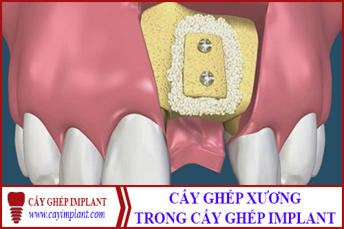 CẤY GHÉP XƯƠNG HÀM TRONG TRỒNG RĂNG IMPLANT LÀ GÌ?