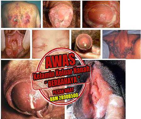 Obat Tradisional Buat Kencing Sakit Keluar Nanah Obat Tradisional Buat Kencing Sakit Keluar Nanah