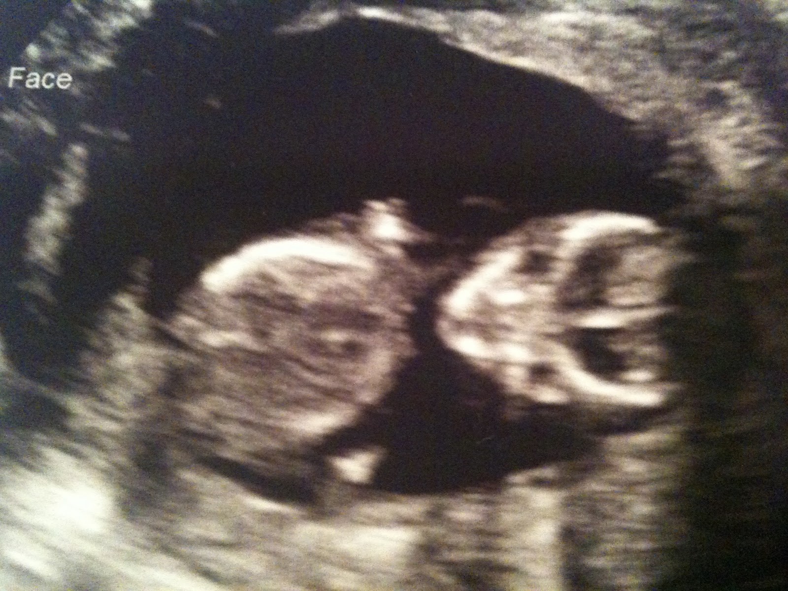 13 недель назад. УЗИ 13 недель беременности в анфас. Снимок УЗИ на 12 неделе. УЗИ 12-13 недель беременности.