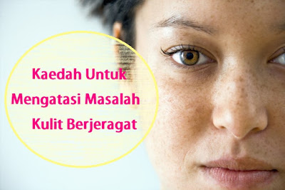 Apa itu Jeragat (Melasma)? - DermaxSuperskin 360 (DMS360)