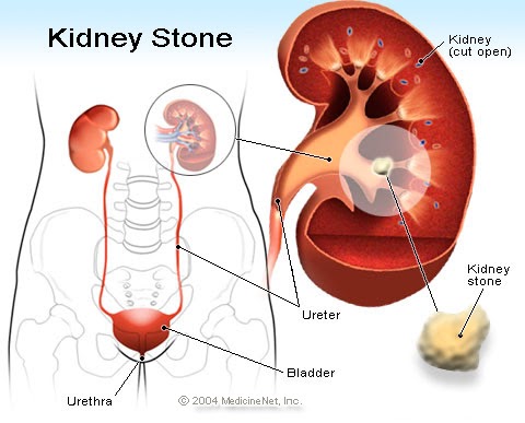 Kidney Stone Avoid Food List Kidney Stone Avoid Food List