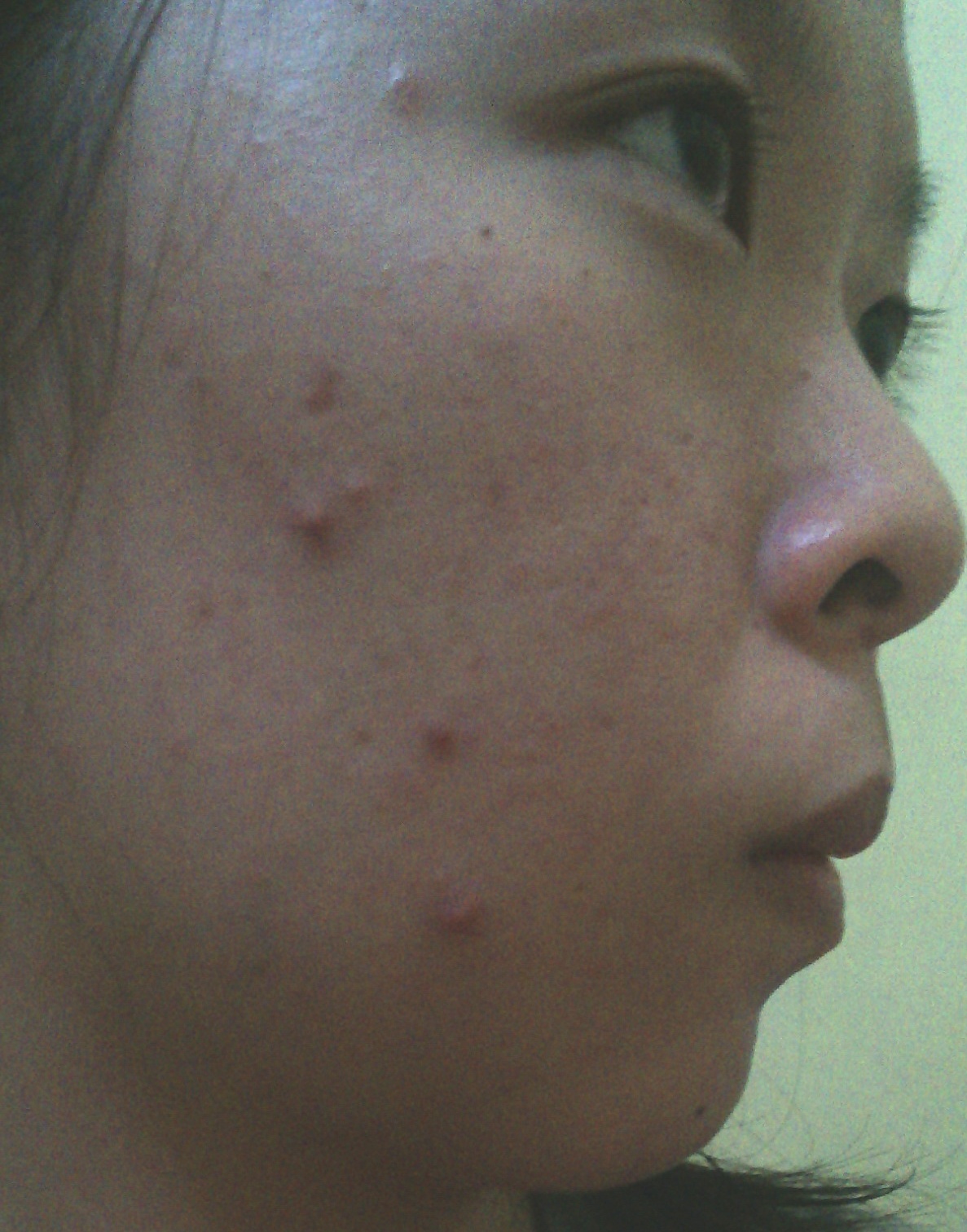 Jerawatan Karena Pakai Sk Ii My Honest Opinion About Facial Treatment Essence