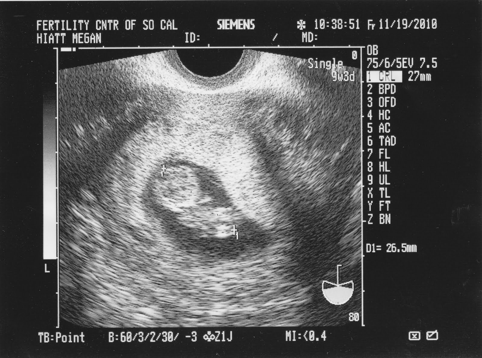 Конец 9 недели. УЗИ 8-9 недель беременности. Плод на 9 неделе беременности по УЗИ. УЗИ 9 недель беременности по УЗИ. Малыш на 9 неделе беременности на УЗИ.