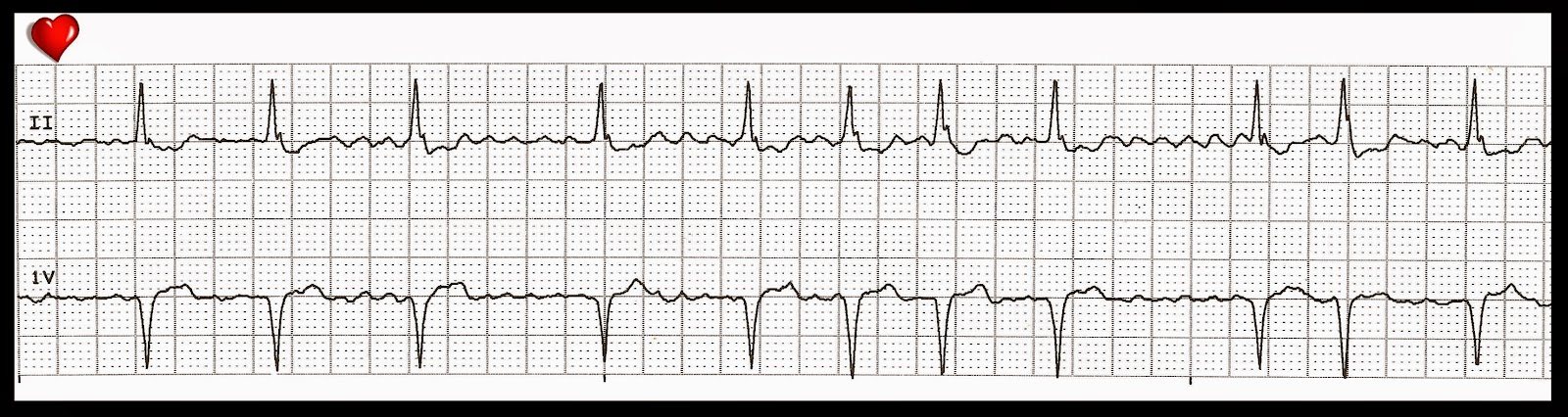 afib flutter afib flutter
