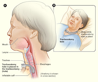 Know the Tracheostomy Procedure, Indications and Risks
