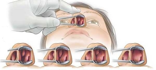 Cara Menghilangkan Benjolan Lunak Di Lubang Hidung Cara Menghilangkan Benjolan Lunak Di Lubang Hidung