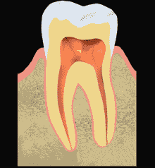root-canal-treatment-information-in-hindi