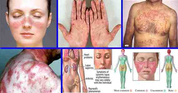 Penyakit Mematikan (HIV/AIDS)