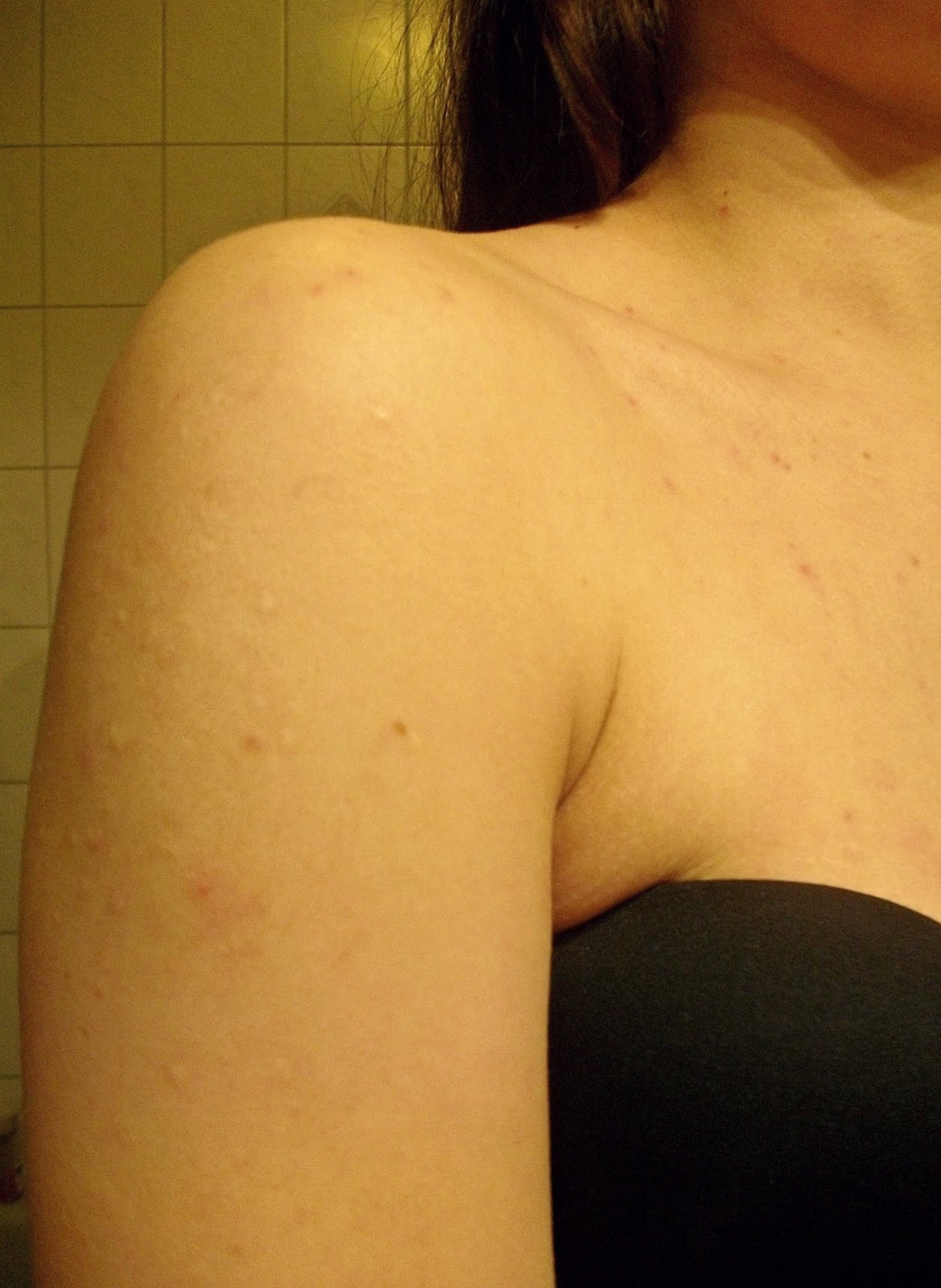 Mein Leben Mit Skin Picking Dermatillomanie Eindrucke Meiner Haut 2