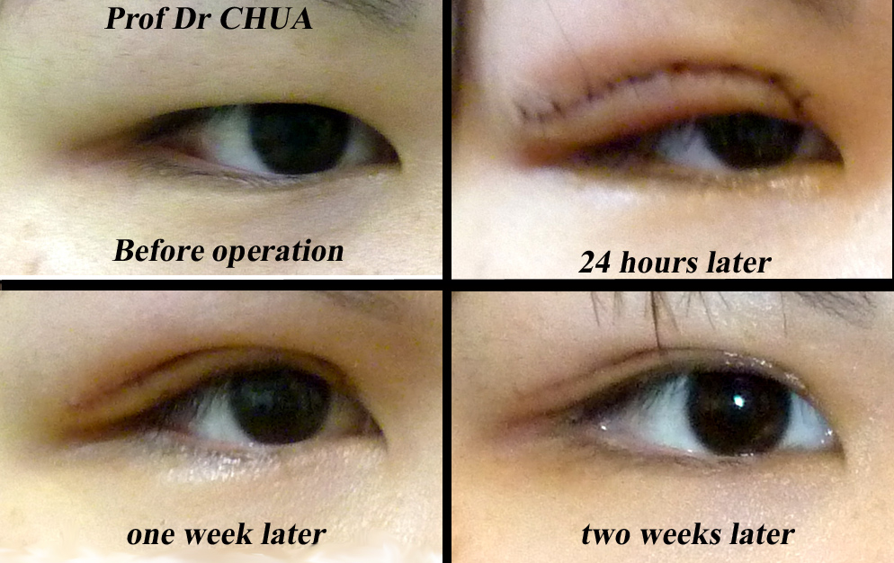 Incision Vs Suture Eyelid Surgery Asian 28