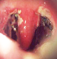 normal post tonsillectomy appearance fauquier ent blog