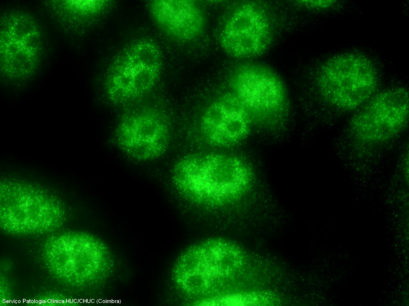 Anticorpos anti SSA (Ro) e anti