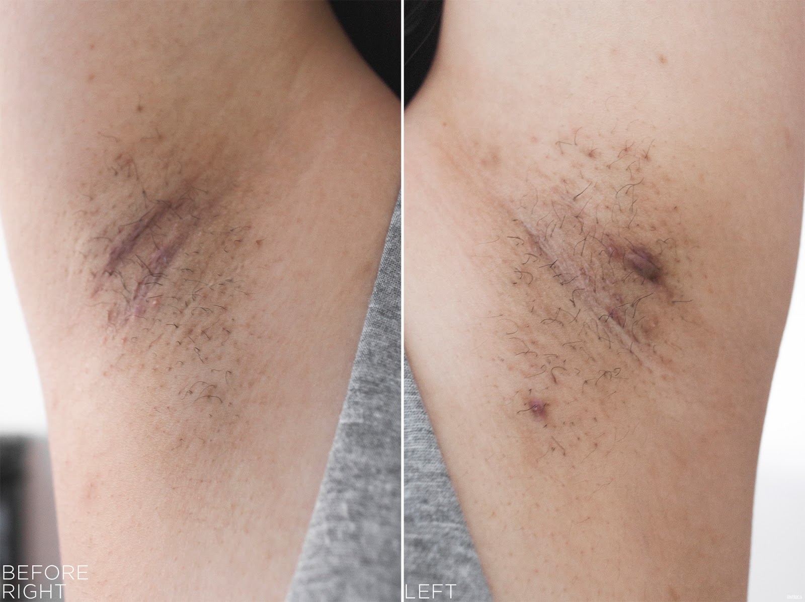 tria Hair Removal Laser Armpits Hair Before