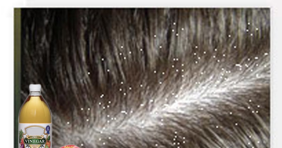 How To Get Rid Of Severe Dandruff Naturally How To Get Rid Of Severe Dandruff Naturally