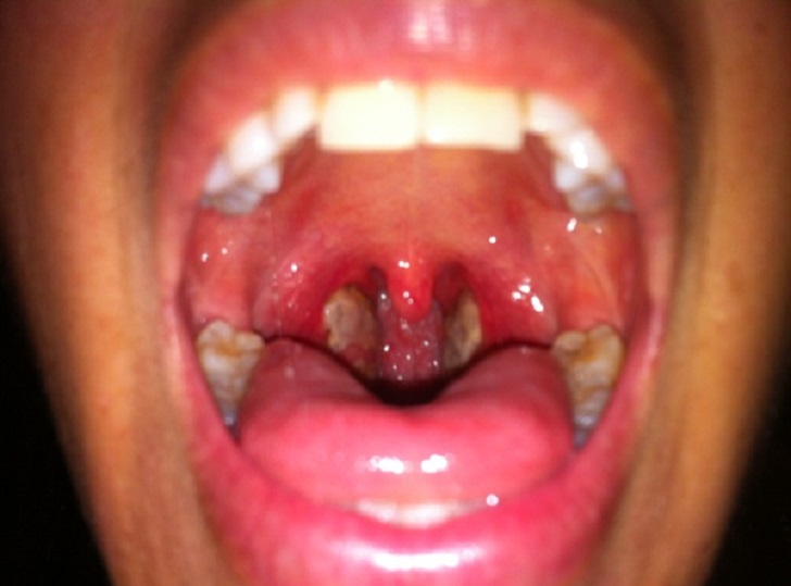 Can You Get Rid Of Strep Naturally Can You Get Rid Of Strep Naturally