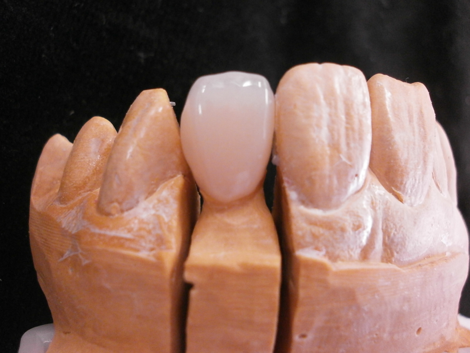 髙田朝（Hajime Takada）のオーダーメイド歯科技工物の紹介 Introduction of custommade dental