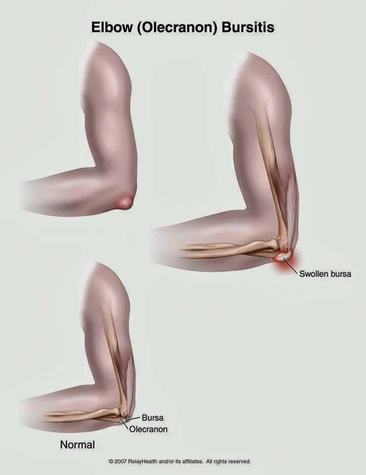 Physio Health Elbow Bursitis
